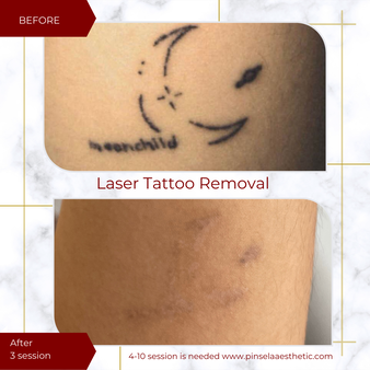 Laser Tattoo Removal in Bali, Pinsela Aesthetic - Pinsela Aesthetic